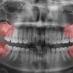 Estrazione dente del giudizio: costo e tutto quello che c’è da sapere