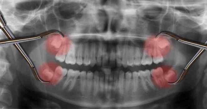 Estrazione dente del giudizio: costo e tutto quello che c’è da sapere
