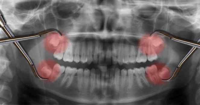 Estrazione dente del giudizio: costo e tutto quello che c’è da sapere