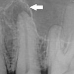Il granuloma dentale: cause, sintomi e diagnosi