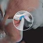 Disturbi della mandibola: dolori articolari, click, affaticamento muscolare