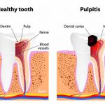 Pulpite dentale: cause, sintomi e rimedi