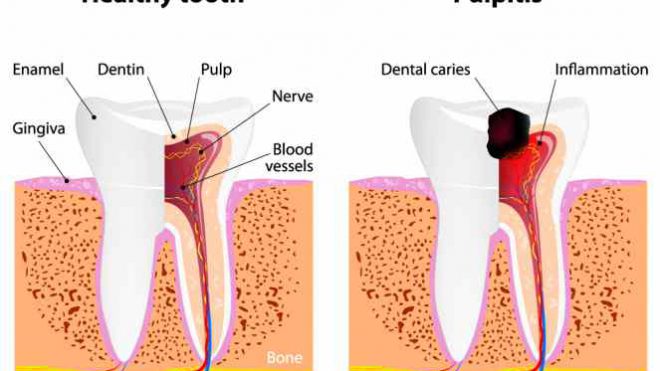 Pulpite dentale: cause, sintomi e rimedi