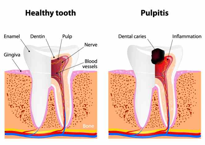 Pulpite dentale: cause, sintomi e rimedi