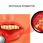 Cos’è la stomatite aftosa: terapia e sintomi