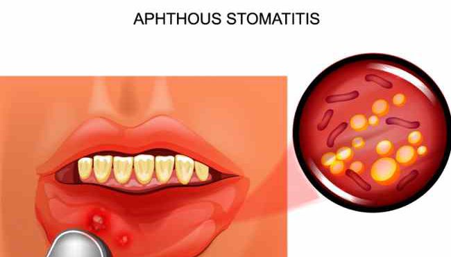 Cos’è la stomatite aftosa: terapia e sintomi