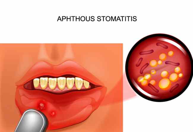Cos’è la stomatite aftosa: terapia e sintomi
