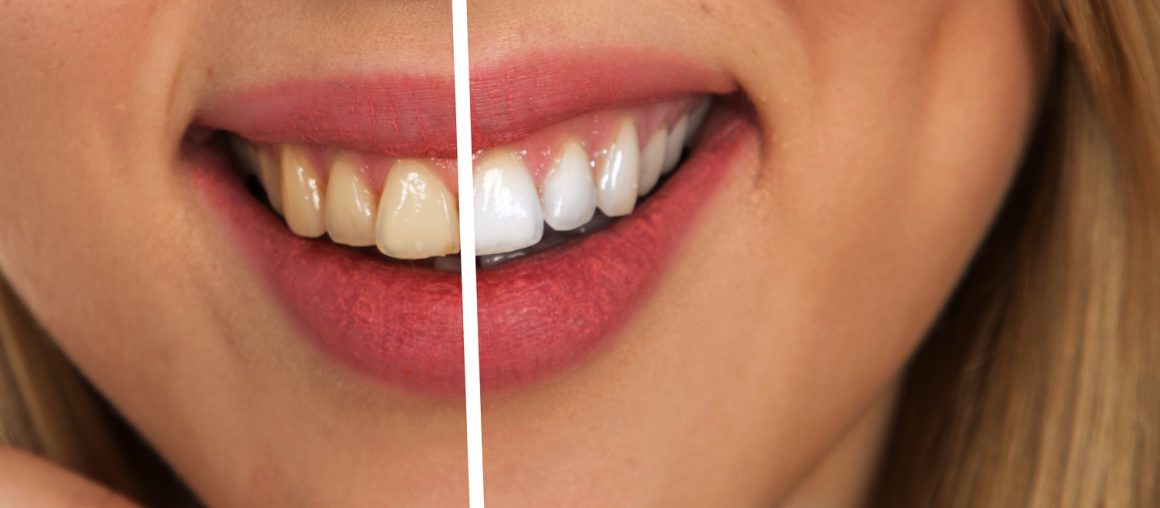 Faccette dentali: costo e opinioni