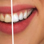 Faccette dentali: costo e opinioni